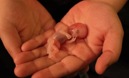 แท้งบุตร (Miscarriage)